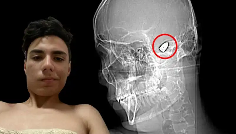 Kafasında Patlamaya Hazır Bomba ile Yaşayan İnsan: Dramatik Hayat Hikayesi